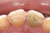 Figure 22  Advanced Triad, Incisal view demonstrates the damage from sleep bruxism and the erosive wear associated with GERD and tongue position.