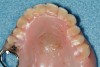 Figure 24 Advanced Triad, Many dentures worn at night demonstrate the same lateral wear facets indicative of the bruxism triad patient. A complete history of bruxism, sleep, and GERD should be obtained.