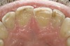 Figure 1  CENTRIC RELATION Exposed dentin such as seen in these incisors is not normal.