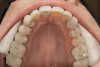 Figure 2  CENTRIC RELATION Stable, even holding contacts on all teeth when the condyles are in CR is a primary sign of occlusal stability.