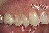 Figure 7  CLINICAL EXAMPLES Teeth Nos. 4 through 6 were loaded excessively in lateral movements; tooth No. 5 was the first tooth to hit in the CR arc of closure.