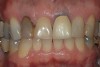 Figure 1  A clinical examination demonstrates a single, very dark lateral incisor and a moderately dark central incisor with a crown on the adjacent central incisor and several dark gingival areas.