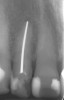 Figure 2  A radiograph finds no pulp chamber in the slightly dark central incisor and a silver point on the darkest lateral incisor. A titrated approach to bleaching was needed using individual tooth treatments.