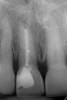 Figure 3  A radiograph will indicate whether the dark color is related to materials remaining in the pulp chamber, leaking restorations, caries, internal resorption, or failed endodontic therapy.