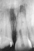 Figure 4  Endodontic therapy was attempted on a tooth with calcific metamorphosis, with subsequent perforation and file fracture in the PDL.