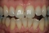 Figure 9  A reasonable match was obtained from about 8 weeks of single-tooth bleaching. Often patients discontinue treatment when the single tooth is no longer a mismatch, even if the outcome is not ideal.