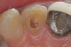 Figure 13   The endodontic access opening should be enlarged until it can be certain that all the remaining brown pulp tissue has been removed from the lateral walls of the pulp chamber as well as the incisal extent. Pulps that became necrotic when the tooth was young often have pulp chambers much larger than the endodontic access opening.