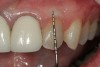 Figure 15  For internal bleaching, the gutta-percha should be removed 2 mm below the CEJ.