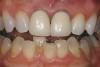 Figure 18  After the tooth being bleached has reached its maximum lightening, the bleaching process should be stopped for 2 weeks to allow the shade to stabilize and the bond strengths to return to normal. Then an opaque whiter composite can be placed in the chamber if needed to further harmonize the tooth color.