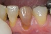 Figure 19  The endodontically treated canine is much darker than the adjacent teeth, but in this less-esthetic area, a full tray was used to lighten all the teeth. The canine was bleached internally with one treatment and externally to completion.