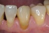 Figure 20  After 3 weeks of external bleaching with 10% carbamide peroxide at night, the adjacent teeth reached their maximum lightness. While the other teeth are slightly lighter than the canine, the color match was much closer and pleasing to the patient.