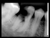 Figure 1  EVALUATION PARAMETERS    The location and extent of the carious lesion make this tooth an easy decision for extraction.