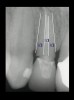 Figure 3  EVALUATION PARAMETERS  The Rule of Thirds: The canal or canal space preparation should not be any wider than one third the mesiodistal root diameter after the endodontic access.