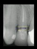 Figure 4  CLINICAL GUIDELINES  The minimum distance needed is 2.5 mm from the osseous crest to the final margin placement to avoid biologic-width impingement. This measurement is meant as a guideline and not an absolute number, as it has been shown to have individual variability. This gives a clinical guideline of 4 mm consisting of 1.5 mm of tooth structure and 2.5 mm biologic width.