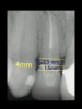 Figure 5  CLINICAL GUIDELINES  The minimum distance needed is 2.5 mm from the osseous crest to the final margin placement to avoid biologic-width impingement. This measurement is meant as a guideline and not an absolute number, as it has been shown to have individual variability. This gives a clinical guideline of 4 mm consisting of 1.5 mm of tooth structure and 2.5 mm biologic width.