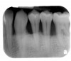 Figure 8  CLINICAL GUIDELINES  Horizontal defects can make guided tissue-regeneration attempts unpredictable.