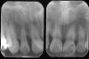 Figure 9  CLINICAL GUIDELINES Narrow vertical defects respond more favorably to regeneration attempts. If periodontal surgery is attempted in the anterior region, the possibility of an esthetic compromise should always be considered regardless of defect morphology.