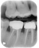 Figure 10  CLINICAL GUIDELINES Class I defects can be treated and maintained predictably; while Class II defects can be treated successfully, their long-term maintenance can be a concern.