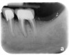 Figure 11   CLINICAL GUIDELINES Class III defects have been shown to have a poor long-term prognosis and should be considered candidates for extraction.