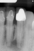 Figure 12  ENDODONTIC AND ESTHETIC PARAMETERS A tooth with a periapical radiolucency > 5 mm significantly decreases the success rate of endodontic therapy.