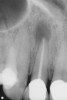Figure 13  ENDODONTIC AND ESTHETIC PARAMETERS It appears that if choosing between the therapies of surgical versus non-surgical to retain teeth, endodontic surgery offers more favorable initial success, but non-surgical re-treatment offers a more favorable long-term outcome.
