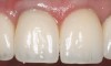 Figure 15 ENDODONTIC AND ESTHETIC PARAMETERS  The same teeth after crown lengthening and a new restoration created a more esthetically pleasing 80% height-to-width ratio.