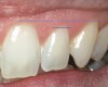 Figure 16  ENDODONTIC AND ESTHETIC PARAMETERS  Gingival symmetry is defined as an imaginary line that should be collinear connecting the central incisors and canines. The gingival margin of the lateral incisor should be even with or coronal to this line by a maximum of 3 mm.