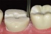 Figure  10  TECHNIQUE An end-cutting bur is used to smooth sharp line angles at the interproximal margins.