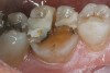 Figure  19  The #330 bur continued through the buccal depth cut to the distal depth cut removing the distal‚Äìbuccal cusp. The existing filling material remained as a temporary reference point.