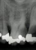 Figure 1   Periapical radiograph of maxillary left first molar. Two-dimensional images lead to two-dimensional thinking.