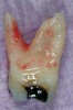 Figure 3   Mesial view of Figure 1 shows true three-dimensional anatomy of the mesial root.