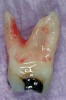 Figure 3   Mesial view of Figure 1 shows true three-dimensional anatomy of the mesial root.