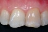 Figure 13   Preoperative view of calcified tooth that had been discolored for 25 years.