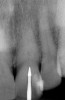 Figure 22   Radiograph with initial penetration of surgical length  friction grip conical carbide bur. A slight redirection of the bur is indicated.