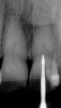 Figure 23   Radiograph of deeper endo-exploration with the latch grip version of the conical carbide bur. Position confirmed as accurate.
