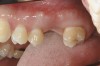 Figure 1  Replacement of a missing tooth has long been a treatment objective to improve oral health and function