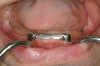 Figure 4  An example of a two-implant tissue bar for an implant-assisted prosthesis.