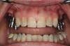 Figure 7  Implants placed more in alignment with natural tooth roots.