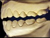 Figure 10  Moderate NCLTS from toothpaste, left facial view.