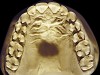 Figure 11  Advanced NCLTS from toothpaste, maxillary arch.