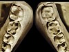 Figure 21  Chronological comparison of 6- and 12-year mandibular molars, soda-swishing.