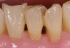 Figure 1  This patient presented with generalized gingival recession of the mandibular anterior teeth. There were no changes in the root surfaces that would indicate the beginning of the demineralization process. Although no surface demineralization process had occurred, these root surfaces would respond to remineralization therapy. The positive changes may include: hard, shiny root surfaces and a reduction in dentinal hypersensitivity.