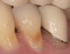 Figure 6  Although discolored, the root surface on the mandibular left first premolar is shiny and will feel hard, smooth, and glass-like when palpated with the side of the explorer. No restoration is necessary.