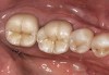 Figure 17  Postoperative photograph of teeth Nos. 18 to 20 in a case with subgingival margins. Photograph courtesy of Yi-Yuan Chang.