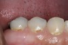 Figure 1  Initial caries. Class V carious lesions.