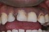 Figure 2  Initial caries. Class III and V carious lesions.