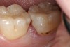 Figure 5  Defective margins. Mandibular second molar with a Class II composite resin with a defective facial–gingival margin.