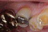Figure 6  Restoration fracture. Fractured isthmus of an amalgam restoration.