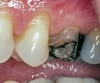 Figure 8  Fractured buccal cusp on a maxillary second premolar.
